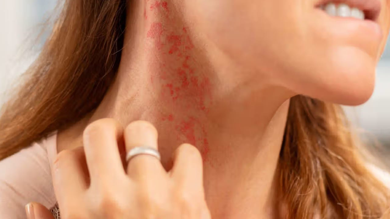 రాత్రిపూట దురద: మీకు రాత్రిపూట తరచుగా దురద, మంట పుట్టినట్టు అనిపిస్తే అది మూత్రపిండాల వైఫల్యానికి సంకేతం కావచ్చు. మీ మూత్ర పిండాలు సరిగ్గా పనిచేయకపోతే.. మన శరీరంలోని అదనపు విషపదార్థాలు అన్ని పేరుకుపోతాయి. దీని కారణంగా చర్మంపై దురద, దద్దుర్లు రావడానికి దారితీస్తుంది.