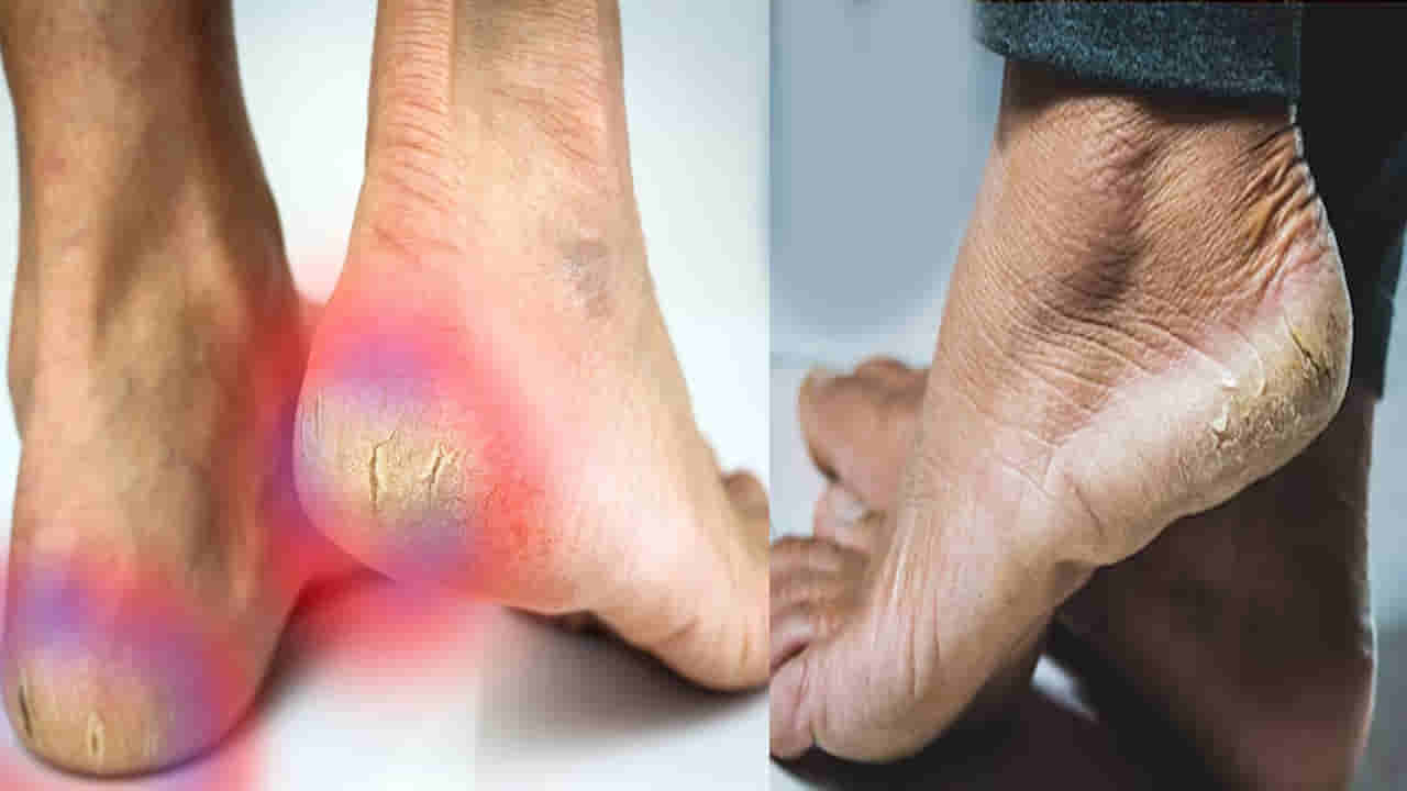 Lifestyle: శీతాకాలంలో మడమలకు పగుళ్లు వస్తున్నాయా? ఇలా చేస్తే మృదువుగా మారుతాయి!