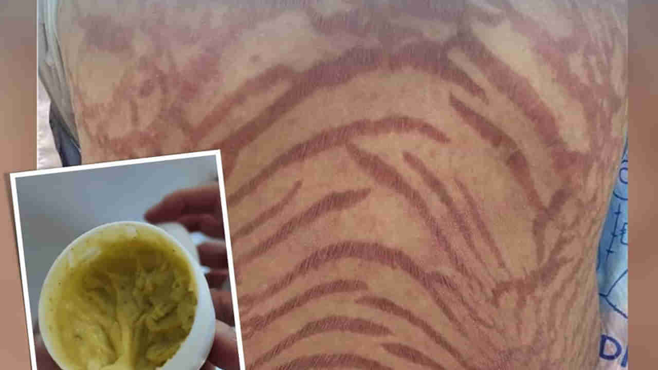 Viral: పదేళ్ల పాటు హెర్బల్ స్కిన్ క్రీమ్ వాడిన మహిళ.. కట్ చేస్తే.. శరీరమంతా పాము మాదిరిగా..