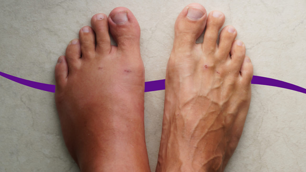 పాదాలలో వాపు: మీ పాదలలో వాపు కూడా కిడ్నీ వ్యాధులను సంకేతం కావచ్చు. ఎందుకంటే శరీరం ఉప్పు, నీటిని సరిగ్గా ఫిల్టర్ చేయకపోతే, పాదాలలో వాపు వస్తుంది. కొన్నిసార్లు సాయంత్రం, రాత్రి సమయంలో చేతుల్లో వాపు కనిపిస్తుంది. ఇది కూడా కిడ్నీ వ్యాధులకు సంకేతం కావచ్చు. కాబట్టి వీటి పట్ల కూడా జాగ్రత్తగా ఉండండి.