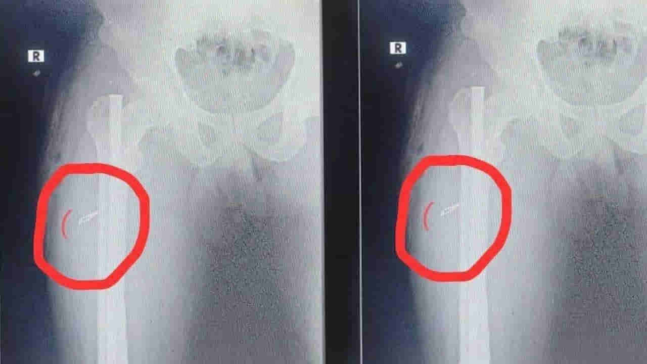 Andhra: ఏడాదిన్నరగా తగ్గని కాలినొప్పి.. స్కానింగ్ చేయగా తుని హాస్పిటల్‌లో అసలు విషయం తేలింది