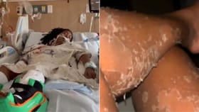 సాలీడు పురుగు కాటుకు గురైన మహిళ.. పాము కుబుసంలా ఒంటిపై చర్మం..