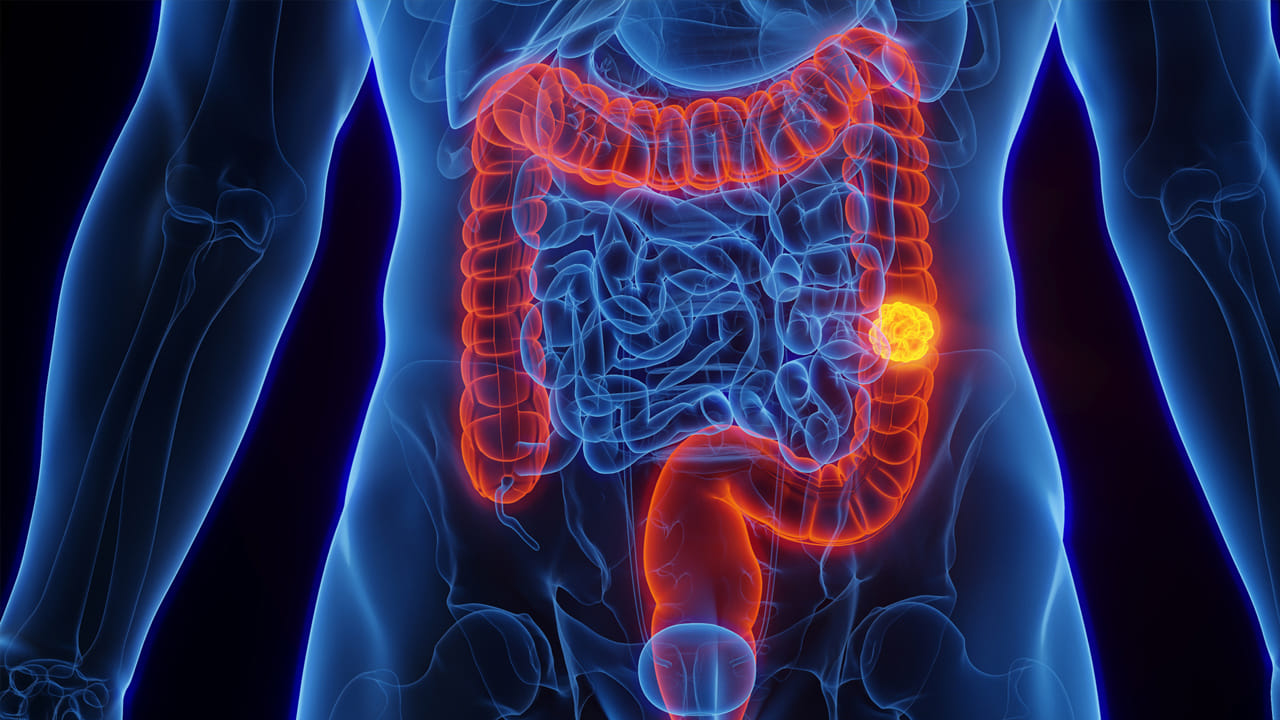 ప్రేగు కదలిక సమస్యలు: సిర్కాడియన్ రిథమ్ ప్రకారం, సూర్యాస్తమయం తర్వాత శరీర అవయవాలు విశ్రాంతి తీసుకోవడం ప్రారంభిస్తాయి. ఆ సమయంలో, రాత్రి భోజనం ఆలస్యంగా లేదా కఠినమైన ఆహారం రూపంలో తిన్నప్పుడు, అది రాత్రంతా జీర్ణం కాకుండా కడుపులోనే ఉంటుంది. జీర్ణవ్యవస్థ మరుసటి రోజు ఉదయం మళ్ళీ పనిచేయడం ప్రారంభిస్తుంది. రాత్రి భోజనం జీర్ణం కావడానికి ముందు, మనం అల్పాహారం తినడం ప్రారంభిస్తాము. మనం స్నాక్స్, తదుపరి భోజనం తిన్నప్పుడు, అవి జీర్ణం కావు. అపానవాయువు, ఉబ్బరం, గుండెల్లో మంటకు కారణమవుతాయి మరియు ఇది దీర్ఘకాలిక స్థితిలో కొనసాగితే, పెద్దప్రేగు క్యాన్సర్ వస్తుంది.