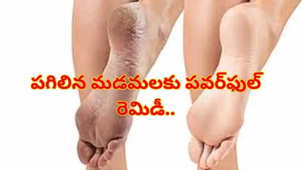 పగిలిన మడమలకు పవర్ఫుల్ పరిష్కారం..! ఇలా చేశారంటే మృదువైన చర్మం మీ సొంతం..