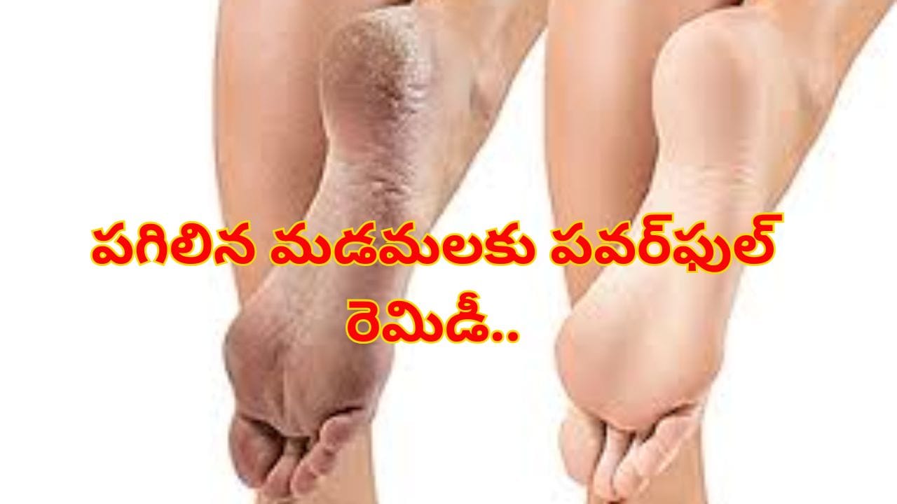 పగిలిన మడమలకు పవర్‌ఫుల్‌ పరిష్కారం..! ఇలా చేశారంటే మృదువైన చర్మం మీ సొంతం..