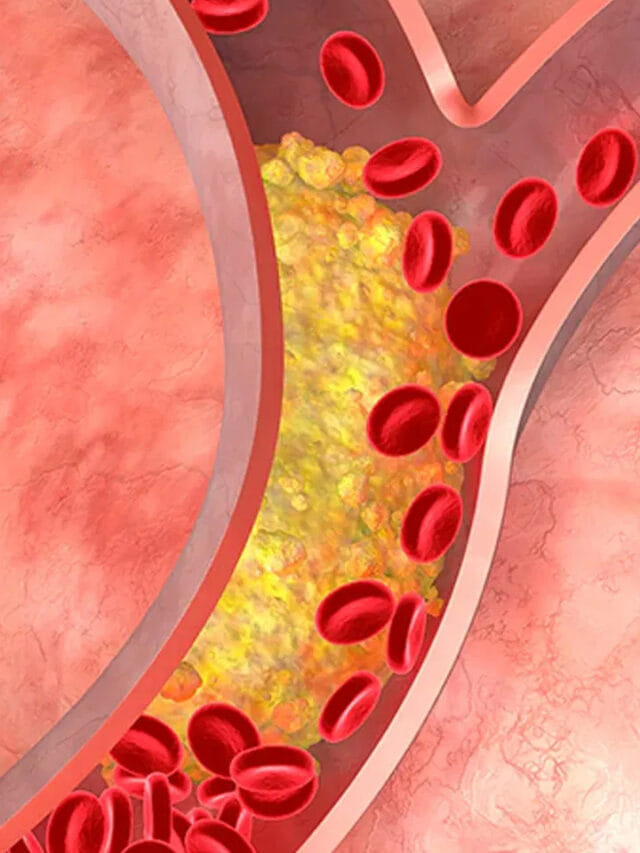 జర జాగ్రత్త.. శరీరంలో కొలెస్ట్రాల్ పెరిగితే కనిపించే లక్షణాలు ఇవే!