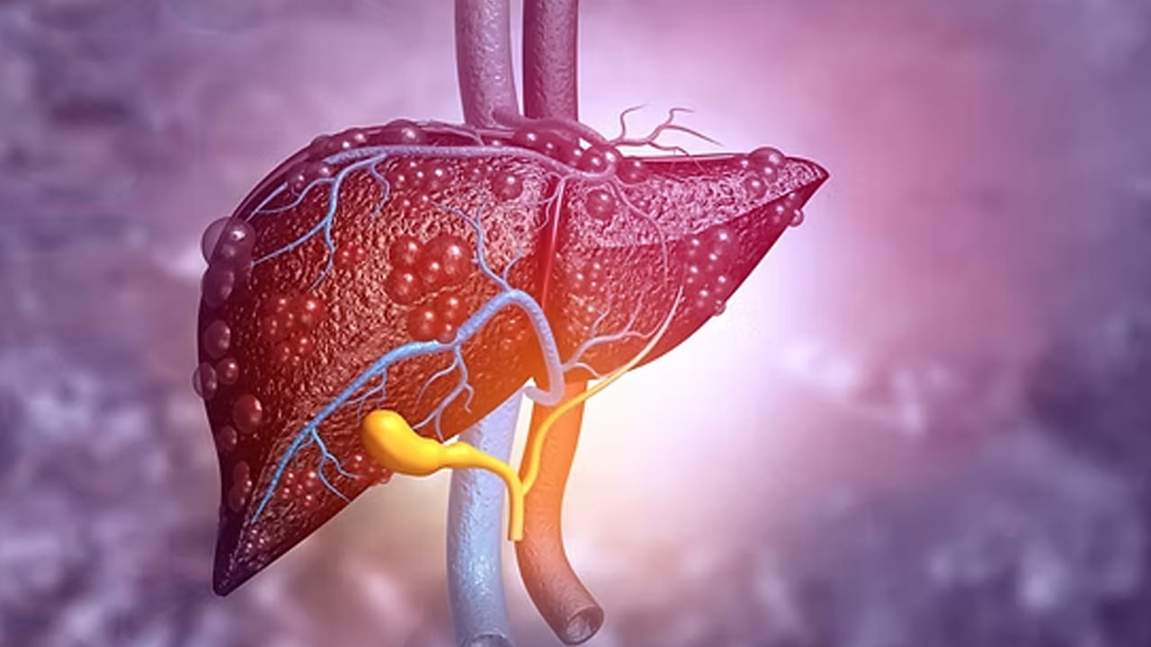 ఎలాంటి పరీక్షలు లేకుండానే.. ఫ్యాటీ లివర్ వ్యాధిని గుర్తించవచ్చు.. ఎలాగంటే..