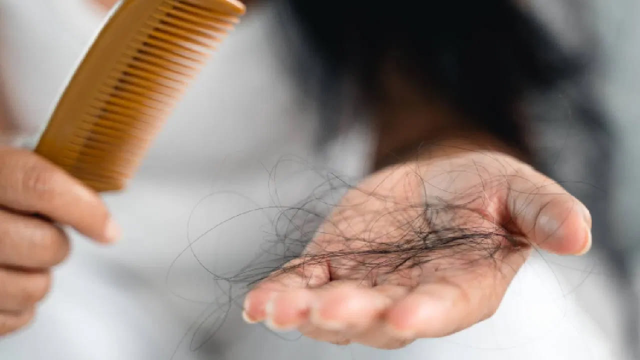 Hair Loss: ఈ ఆహారాలు తింటే బట్టతల గ్యారెంటీ..! కాస్త చూస్కోండి