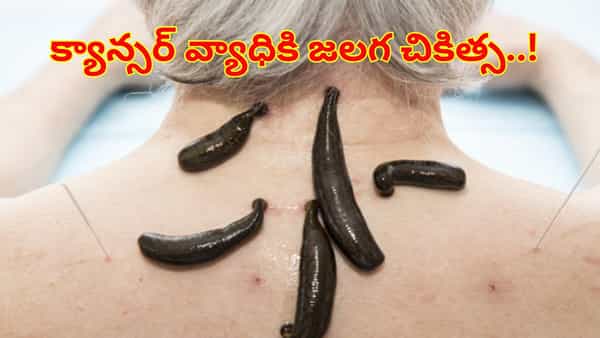 Leech Therapy: జలగ చికిత్స క్యాన్సర్ను నయం చేయగలదా? నిపుణులు ఏం చెబుతున్నారంటే..