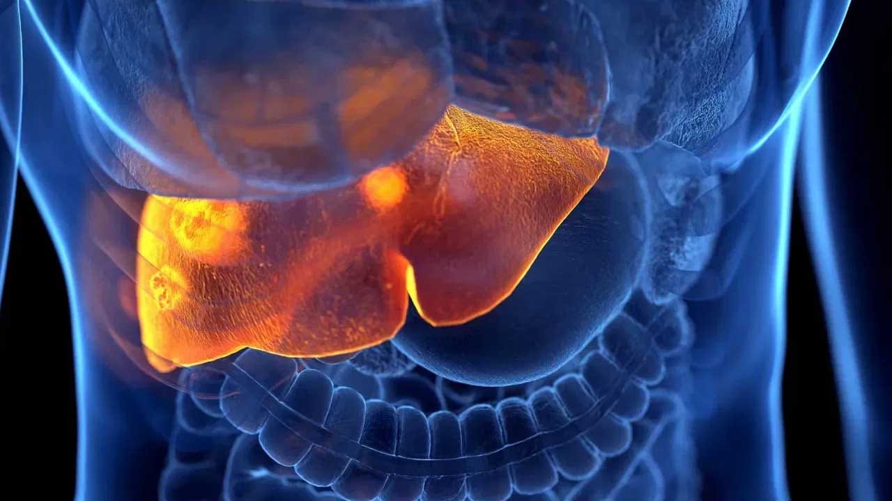 కాలేయ క్యాన్సర్ ఉంటే, కళ్లు, చర్మం పసుపు రంగులోకి మారడం వంటి లక్షణాలు ఏర్పడుతుంటాయి . ఒక వేళ మీకు కామెర్లు వచ్చి, ఎక్కువ కాలం అలాగే ఉన్నా కూడా అది కాలేయ క్యాన్సర్ ప్రారంభ లక్షణమే అంటున్నారు ఆరోగ్య నిపుణులు.