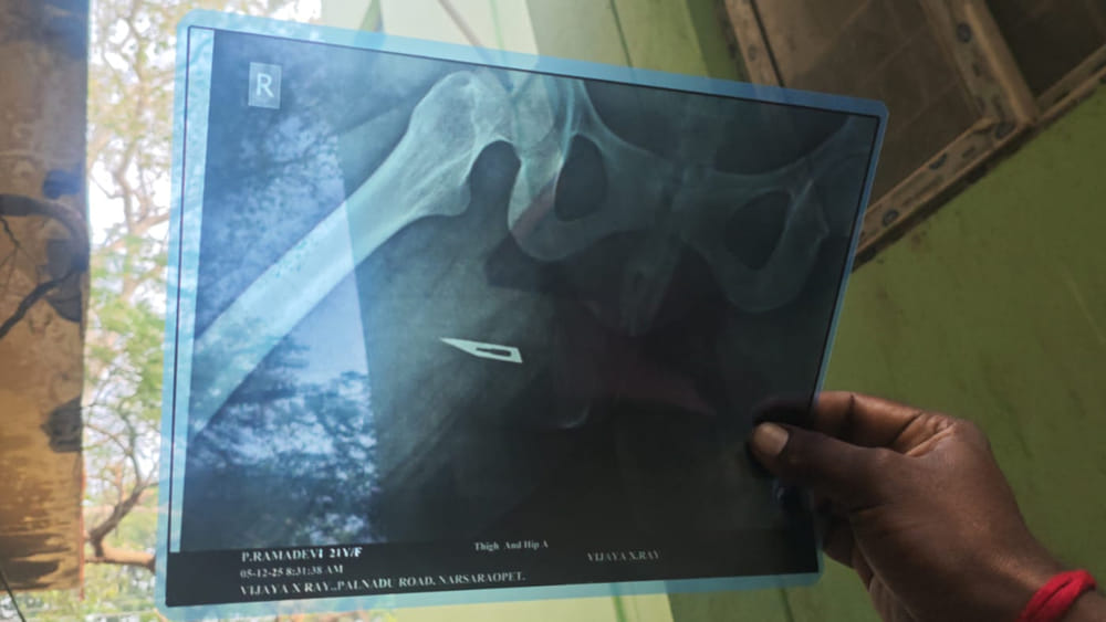 Andhra Pradesh: ఓరీ దేవుడో ఇదేం వైద్యం..! కుటుంబ నియంత్రణ ఆపరేషన్ లో సర్జికల్ బ్లేడ్ మర్చిపోయిన డాక్టర్లు