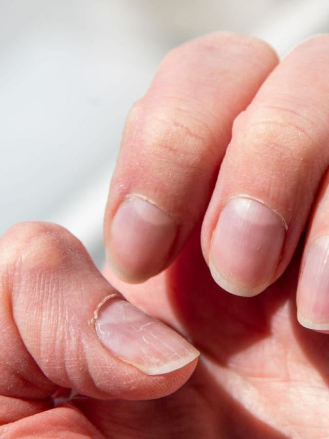 ఆరోగ్యాన్ని వెళ్లడిస్తున్న గోర్లు.. ఎలా ఉంటే ఏ సమస్యలు ఉన్నట్లో చూడండి!