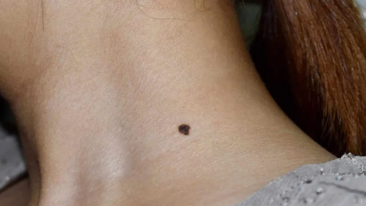 అలాగే మెడపై లేదా గొంతుపై పుట్టు మచ్చ ఉన్న వ్యక్తి గత జన్మలో శారీరకంగా, మానసికంగా అణచివేతకు గురి అయ్యాడని అర్థం, అలాగే ఛాతిపై పుట్టు మచ్చ ఉన్న వ్యక్తి గత జన్మలో ఎక్కువగా ఒత్తిడితోనే కాలం వెళ్లదీశారని అర్థం, అంతే కాకుండా పొట్టపై పుట్టు మచ్చ ఉన్న వ్యక్తి గత జన్మలో స్వతంత్రంగా జీవించలేకపోయారని అర్థం, వీపు పై పుట్టుమచ్చ ఉన్న వ్యక్తి గత జన్మలో అనేక ఇబ్బందులు ఎదుర్కున్నారని అర్థం అని చెబుతున్నారు నిపుణులు. ( నోట్ : పై సమాచారం కేవలం ఇంటర్నెట్ ఆధారంగా మాత్రమే ఇవ్వడం జరిగింది. టీవీ9 తెలుగు దీనిని ధృవీకరించలేదు )