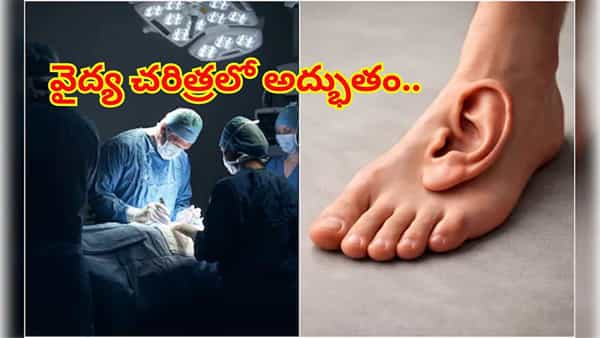 అద్భుత శస్త్రచికిత్స: తెగిపోయిన చెవిని కాలికి అమర్చి, తిరిగి తలకు అతికించిన వైద్యులు