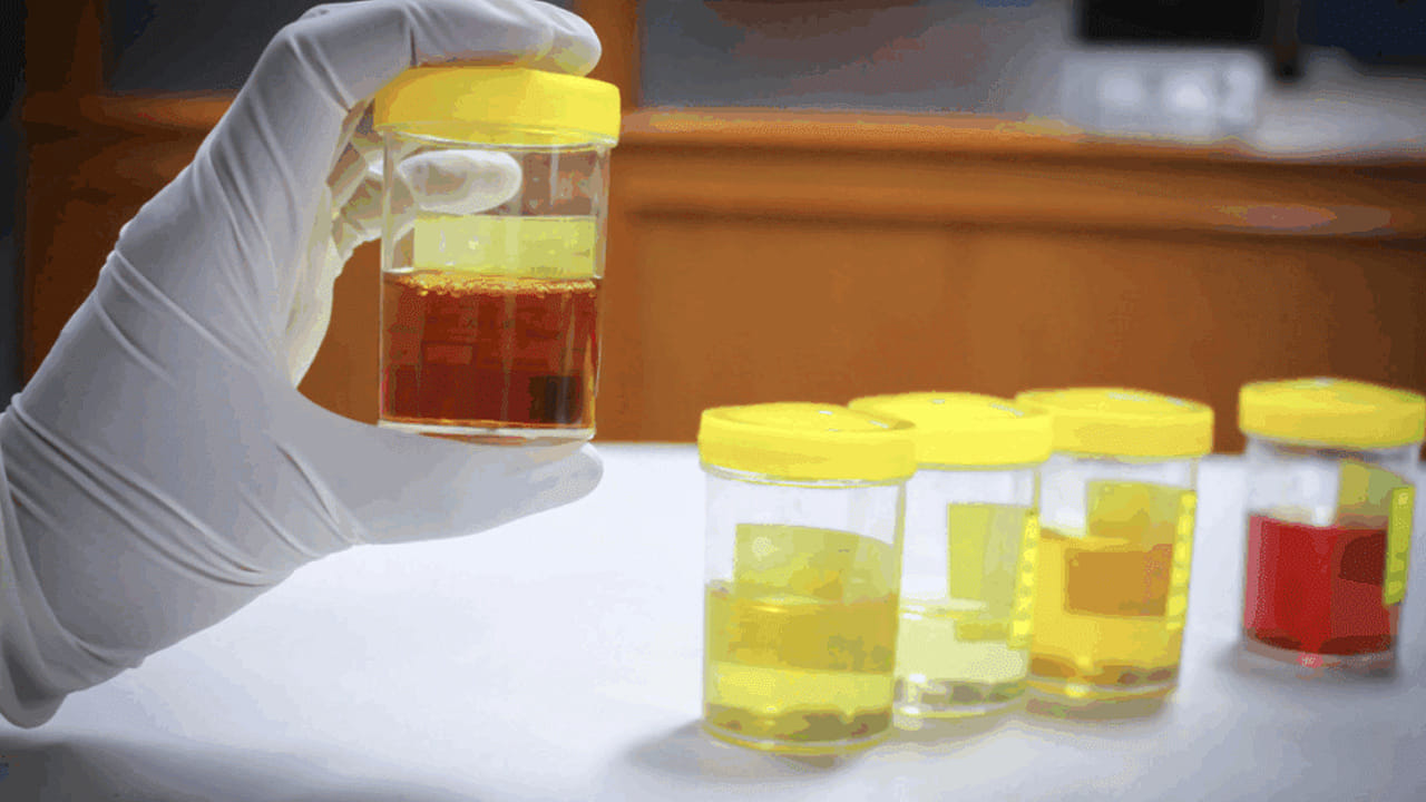 ప్రోస్టేట్ క్యాన్సర్ లక్షణాలు: వృషణ క్యాన్సర్ ప్రారంభ దశలో స్పష్టమైన లక్షణాలు కనిపించవు. ప్రోస్టేట్ క్యాన్సర్ లక్షణాలు కనిపించే సమయానికి, వ్యాధి ఇప్పటికే కొన్ని దశలకు చేరుకుంది. ఆ దశలలో, చికిత్స కొంచెం కష్టమవుతుంది. మీ మూత్రం గులాబీ లేదా ఎరుపు రంగులో కనిపిస్తే, మీరు వెంటనే వైద్యుడిని లేదా నెఫ్రాలజిస్ట్‌ను సంప్రదించాలి. రక్తస్రావం మాత్రమే లక్షణం కాదు. మూత్ర విసర్జన చేస్తున్నప్పుడు మంటగా అనిపించినా కూడా పరీక్షించుకోవడం ముఖ్యం. అంటే, మీ మూత్రంలో రక్తం ఉంటే, మీరు దానిని విస్మరించకూడదు. మీరు వెంటనే వైద్యుడిని సంప్రదించాలి.