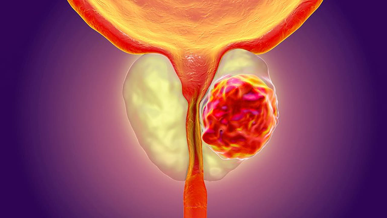 ఎందుకు సరిగ్గా మూత్ర విసర్జన చేయలేరు: మీకు మూత్ర విసర్జన చేయాలని అనిపిస్తుంది, కానీ మీరు చేయలేరు. మీ మూత్రాశయం ఖాళీగా ఉండి, మీరు ఇంకా ఇలాగే ఉంటే, అది పెద్ద విషయం కాదు. మీ మూత్రాశయంలో మూత్రం చిక్కుకుపోయి మీరు మూత్ర విసర్జన చేయలేనప్పుడు ఇది జరుగుతుంది. మూత్ర విసర్జన మీ వృషణం గుండా వెళుతుంది. క్యాన్సర్ అభివృద్ధి చెందినప్పుడు, మూత్ర విసర్జన నాళం ఇరుకుగా మారుతుంది, దీనివల్ల మూత్రం ముందుకు కాకుండా వెనుకకు ప్రవహిస్తుంది. కొన్నిసార్లు, మీ మూత్రాశయం నుండి మూత్రాన్ని బయటకు తీయడానికి ఒక కృత్రిమ కాథెటర్‌ను చొప్పించవచ్చు.