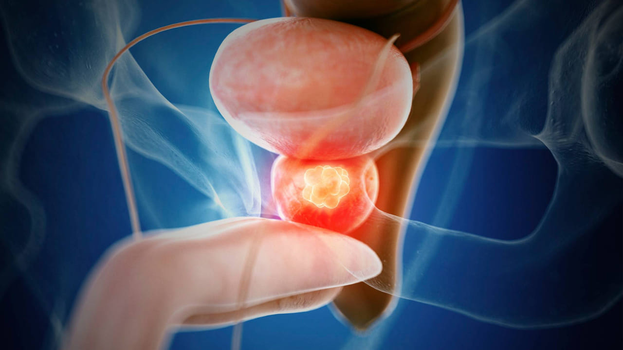 ప్రోస్టేట్ క్యాన్సర్ అనేది వృషణాల క్యాన్సర్: గతంలో మధ్య వయస్కులైన పురుషులను ప్రభావితం చేసే వృషణ క్యాన్సర్, ఇప్పుడు యువకులను కూడా ప్రభావితం చేస్తోంది. ఇటీవలి అధ్యయనం ప్రకారం, యునైటెడ్ స్టేట్స్‌లో వృషణ క్యాన్సర్ ప్రమాదం రోజురోజుకూ పెరుగుతోంది.  పురుషుల వృషణాలలో వచ్చే ఈ క్యాన్సర్, మీరు ఎంత జాగ్రత్తగా ఉన్నా నియంత్రించడం కొంచెం కష్టం. అందువల్ల, లక్షణాలను ముందుగానే గుర్తించి తగిన చికిత్స పొందడం చాలా ముఖ్యం అని వైద్య నిపుణులు అంటున్నారు.