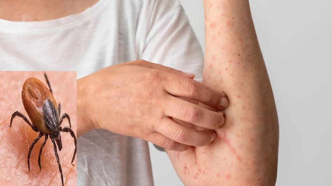 Scrub Typhus: ప్రజలను భయపెడుతున్న స్క్రబ్ టైఫస్.. లక్షణాలు, నివారణ చర్యలు!