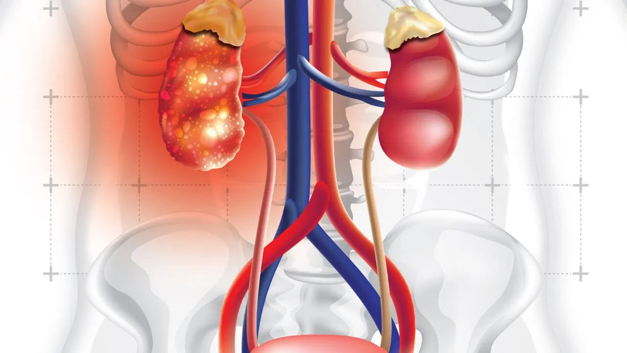 Tomatoes And Kidney Stones Myth
