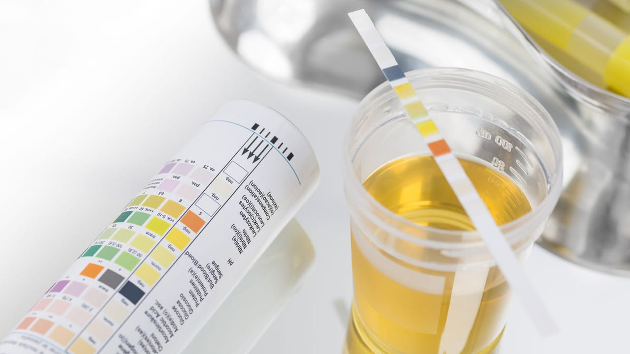 మూత్రపిండాల పనితీరును తనిఖీ చేయడానికి మూత్ర పరీక్ష:  మూత్రపిండాల ఆరోగ్యాన్ని పర్యవేక్షించడానికి, అంచనా వేయడానికి క్రమం తప్పకుండా మూత్ర పరీక్షలు అవసరం. ఈ పరీక్షను డిప్ స్టిక్ మూత్ర పరీక్ష అంటారు. ఇది మూత్రంలో ప్రోటీన్ విసర్జించబడుతుందో లేదో నిర్ణయించే పరీక్ష. ACRను లెక్కించడానికి ఉపయోగించే ఈ పరీక్ష, మూత్రంలోని అల్బుమిన్ ప్రోటీన్‌ను గుర్తిస్తుంది. ACR స్థాయి 30 కంటే తక్కువగా ఉండాలి.