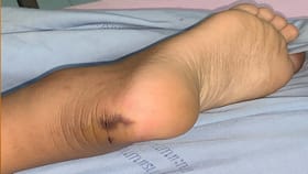 పాము కాటుతో మహిళ మృతి.. మూడేళ్లకు..!