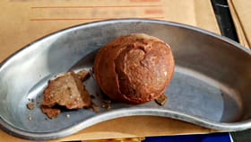 అతడి కడుపులో 500 గ్రాముల కిడ్నీ రాయి.. విజయవంతంగా సర్జరీ!