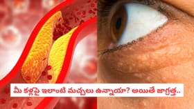 మీ కళ్లపై ఇలాంటి మచ్చలు ఉన్నాయా? అయితే జాగ్రత్త..