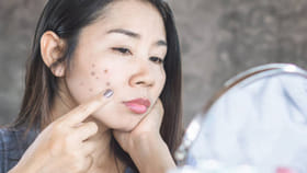 ముఖంపై మొటిమలు నల్లమచ్చలతో బాధపడుతున్నారా.. సింపుల్ టిప్స్ మీకోసం