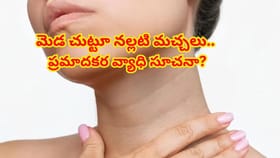 మెడ చుట్టూ నల్లటి వలయం ఏర్పడిందా ! నిర్లక్ష్యం చేయొద్దు..