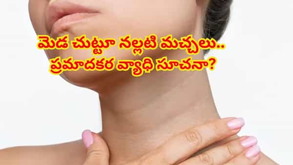 Darkness around the neck: మెడ చుట్టూ నల్లటి వలయం ఏర్పడిందా ! నిర్లక్ష్యం చేయొద్దు.. ఈ వ్యాధి ఉండొచ్చు?