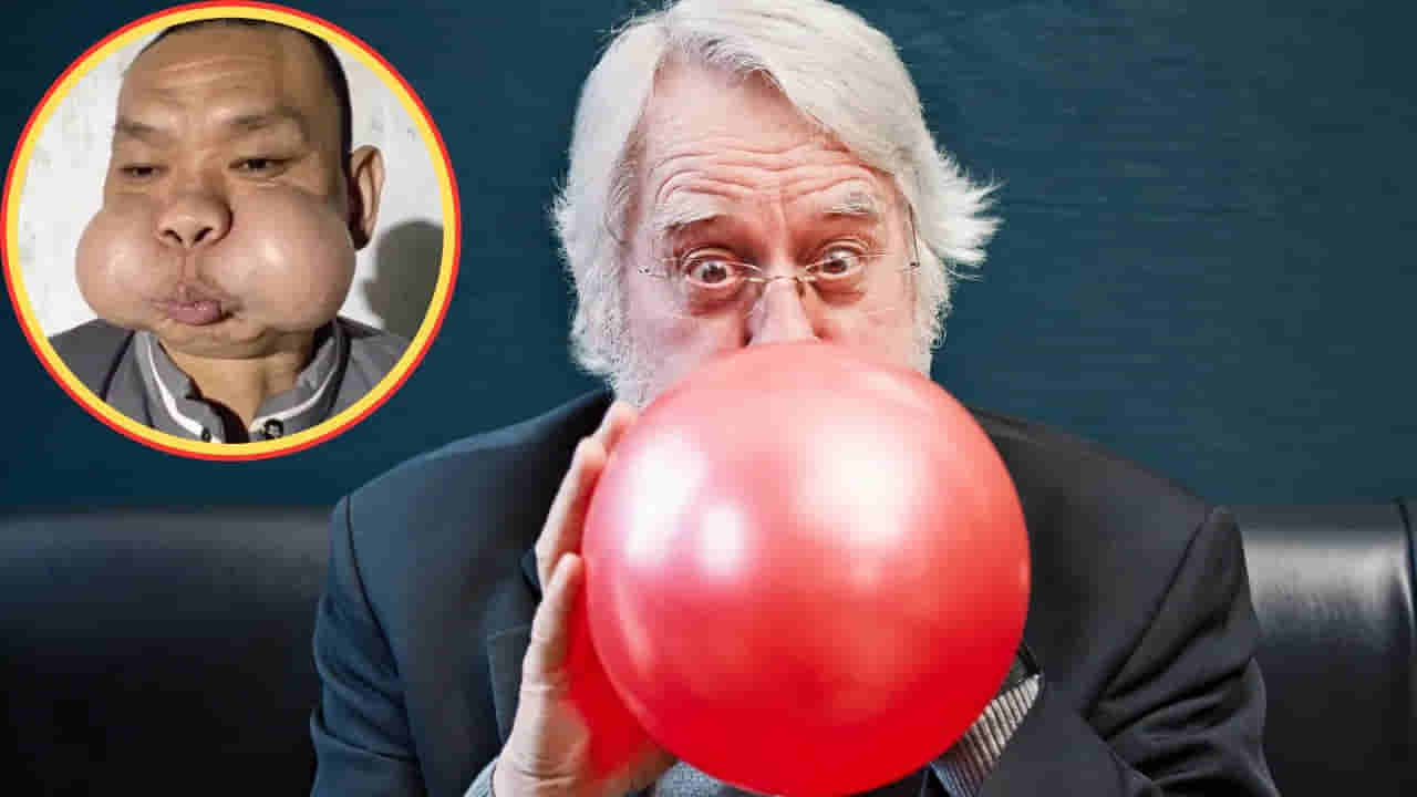 బూరెల్లా కాదు.. బెలూన్లలా ఉబ్బిన బుగ్గలు.. 30 ఏళ్ల కష్టానికి ఫలితం!