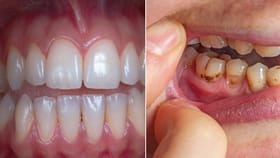 పళ్లు ఊడిపోతే పోషకాహార లోపం! చిరునవ్వు వెనుక దాగున్న దీర్ఘాయువు