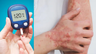 Darkness around the neck: మెడ చుట్టూ నల్లటి వలయం ఏర్పడిందా ! నిర్లక్ష్యం చేయొద్దు.. ఈ వ్యాధి ఉండొచ్చు?