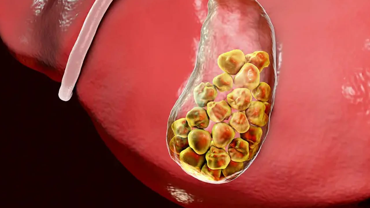 ముఖ్యంగా  పిల్లల నుంచి పెద్ద వారి వరకు ఎవ్వరైనా సరే పదే పదే కడుపు నొప్పి వంటి సమస్యలు ఎదురు అయినప్పుడు నిర్లక్ష్యం చేయకుండా వైద్యుడిని సంప్రదించాలని చెబుతున్నారు ఆరోగ్య నిపుణులు. నోట్ పై సమాచారం ఇంటర్నెట్ ఆధారంగా మాత్రమే ఇవ్వడం జరిగింది. టీవీ9 తెలుగు దీనిని ధృవీకరించలేదు.