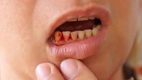 చిగుళ్లలో బ్లీడింగ్? డయాబెటిస్, గుండె జబ్బులకు సంకేతమా?