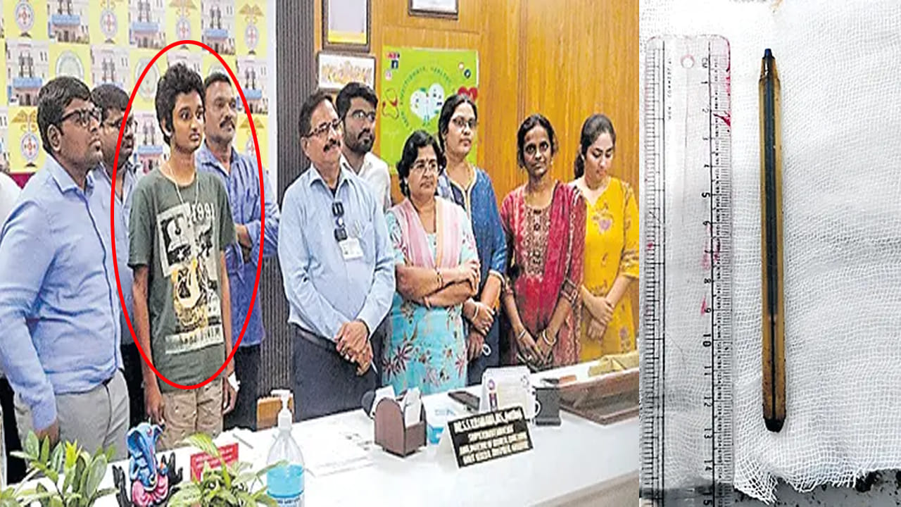 ఫ్రెండ్స్‌తో రూ.50 పందెం .. అమాంతం పెన్ మింగిన విద్యార్ధి! కట్ చేస్తే మూడేళ్ల తర్వాత షాకింగ్ సీన్