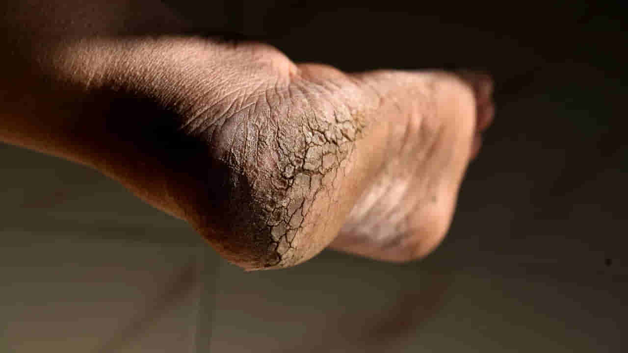 పాదాల పగుళ్లను చిటికెలో నయం చేసే ఇంటి చిట్కాలివో..