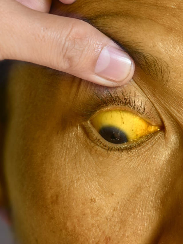 కామెర్లు వచ్చినప్పుడు తప్పక తీసుకోవాల్సిన ఫుడ్ ఏదో తెలుసా?