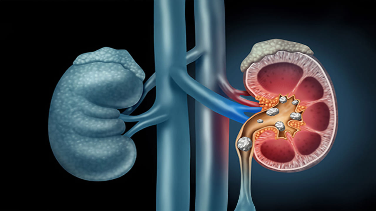 Kidney Stones: తక్కువ నీళ్లు తాగితే కిడ్నీల్లో రాళ్లు వస్తాయా? ఈ డౌట్ మీకూ ఉందా..
