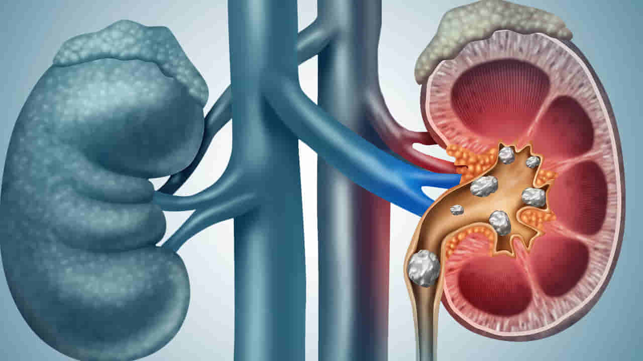 Kidney Stones: మూత్ర పిండాల్లో రాళ్లు ప్రమాదకరమా? శస్త్రచికిత్స ఎప్పుడు అవసరమో తెలుసుకోండి