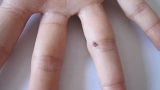 Moles: ఆడవారికి, మగవారికి పుట్టుమచ్చలు ఎక్కడ ఉంటే మంచిది..?