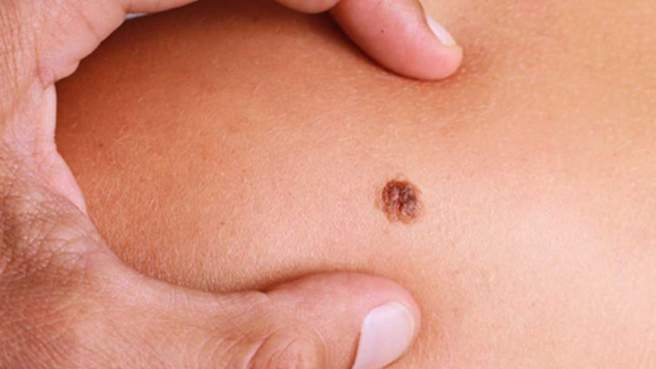 మీకు అక్కడ పుట్టుమచ్చ ఉందా? మీరు రిచ్ అవడం ఖాయం!