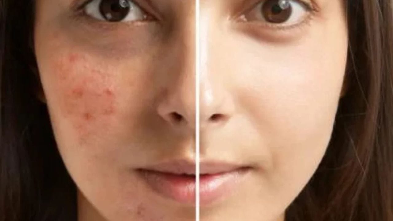 Pimples Reducing Tips: మొటిమలు, బ్లాక్ హెడ్స్ సమస్యలతో బాధపడుతున్నారా? ఈ సింపుల్‌ టిప్స్‌ ట్రై చేశారంటే..