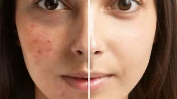 Pimples Reducing Tips: మొటిమలు, బ్లాక్ హెడ్స్ సమస్యలతో బాధపడుతున్నారా? ఈ సింపుల్ టిప్స్ ట్రై చేశారంటే..