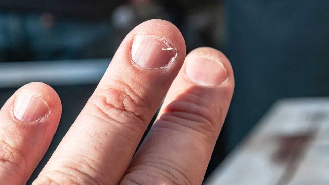 గోళ్లపై నల్లటి గీతలు: ఎటువంటి దెబ్బ తగలకుండానే గోళ్ల కింద నల్లటి లేదా ముదురు రంగు గీతలు కనిపిస్తే అది చర్మ క్యాన్సర్ లక్షణం కావచ్చు. దీనిని వెంటనే వైద్యులకు చూపించడం అత్యవసరం.