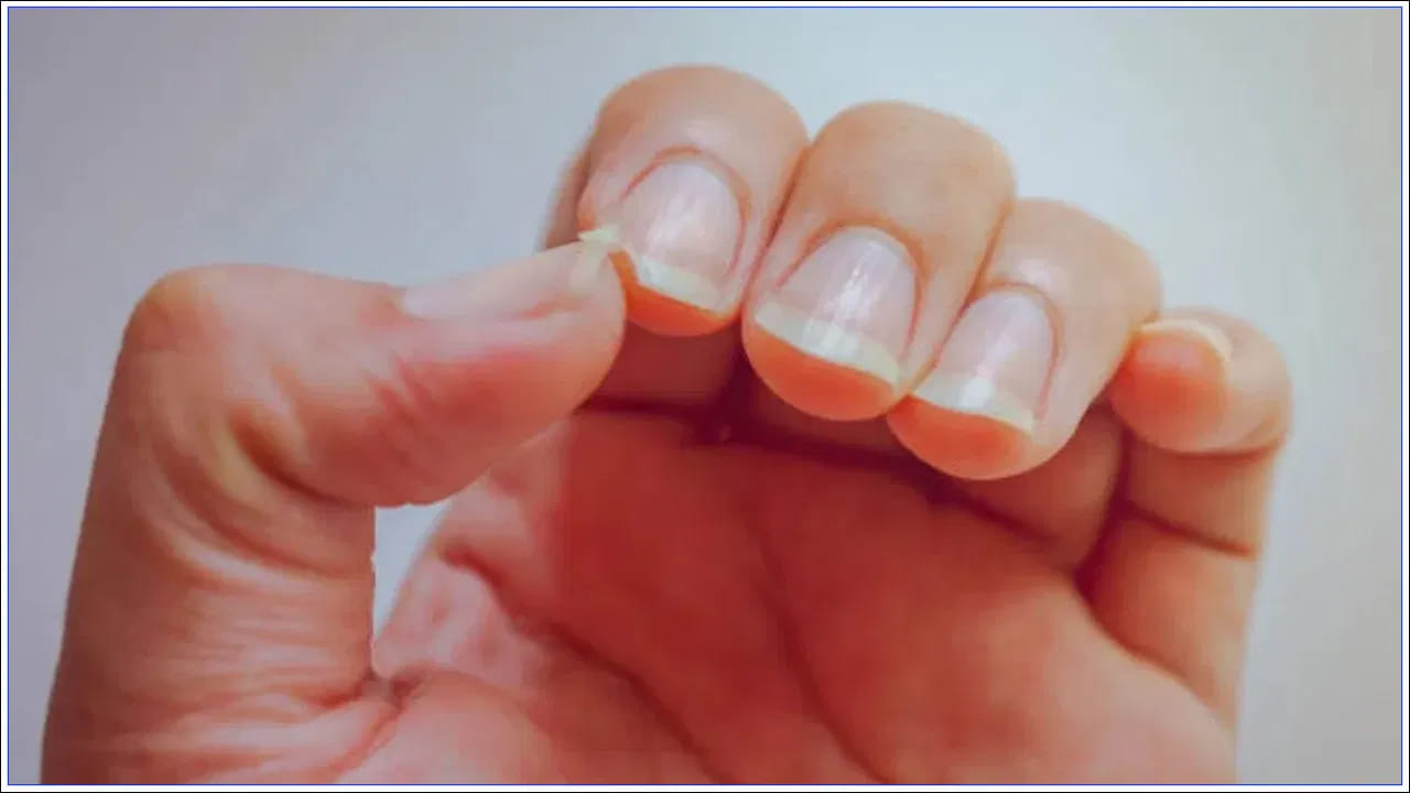 నెయిల్ క్లబ్బింగ్
గోళ్లు వెడల్పుగా మారి, గదలాగా ఉబ్బినట్లు కనిపిస్తే దానిని నెయిల్ క్లబ్బింగ్ అంటారు. ఇది ఊపిరితిత్తుల క్యాన్సర్ లేదా దీర్ఘకాలిక గుండె సమస్యలను సూచిస్తుంది.
