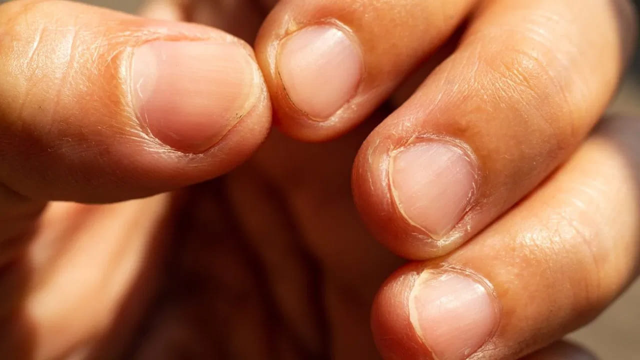 పసుపు రంగు గోళ్లు: గోళ్లు పసుపు రంగులోకి మారితే అది సాధారణంగా ఫంగల్ ఇన్ఫెక్షన్‌ను సూచిస్తుంది. అయితే ఇది ఎక్కువ కాలం కొనసాగితే.. థైరాయిడ్, ఊపిరితిత్తుల సమస్యలు లేదా మధుమేహం వంటి తీవ్రమైన అనారోగ్యాలకు సంకేతం కావచ్చు.