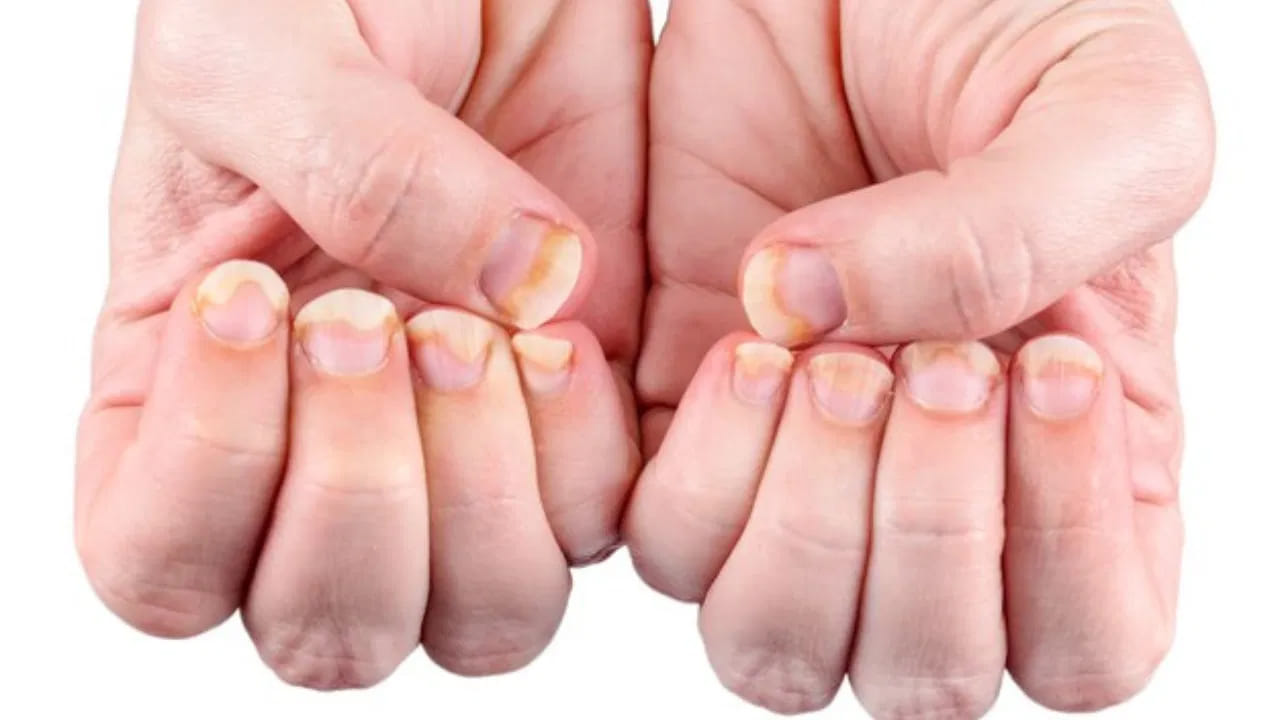 తెల్లటి మచ్చలు: గోళ్లపై వచ్చే తెల్లటి మచ్చలను ల్యూకోనిచియా అంటారు. ఇవి చిన్నపాటి గాయాల వల్ల లేదా అలర్జీల వల్ల రావచ్చు. కానీ, గోరు మొత్తం తెల్లగా మారడం ప్రారంభిస్తే అది శరీరంలో పోషకాల లోపాన్ని లేదా ఇతర ఇన్ఫెక్షన్లను సూచిస్తుంది.