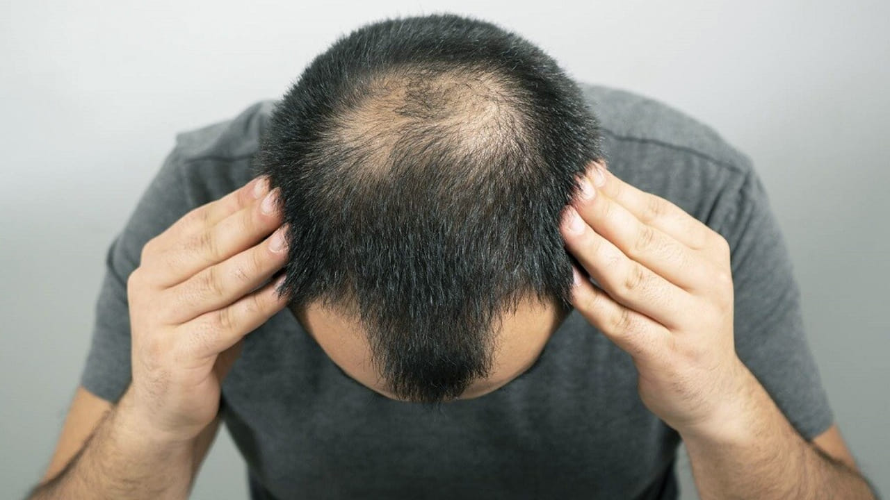 మగవారిలో ఎంతో మంది బట్ట తల సమస్యతో బాధ పడుతున్నారు. అయితే, ఇది ఎందుకు వస్తుందో కొంచం కూడా ఆలోచించకుండా హాస్పిటల్స్ చుట్టూ తిరుగుతూనే ఉంటారు. అయినా కూడా ఎలాంటి ప్రయోజనం ఉండదు. 
