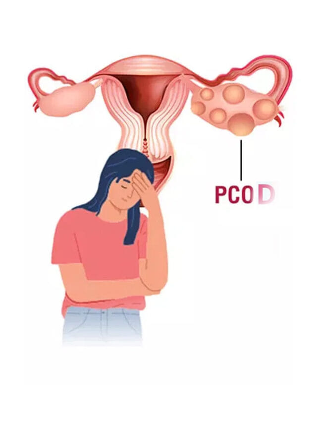 మహిళలూ జాగ్రత్త.. PCOD సమస్యకు అసలు కారణం ఇదే!